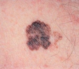 Симптомы рака кожи, не являющегося меланомой